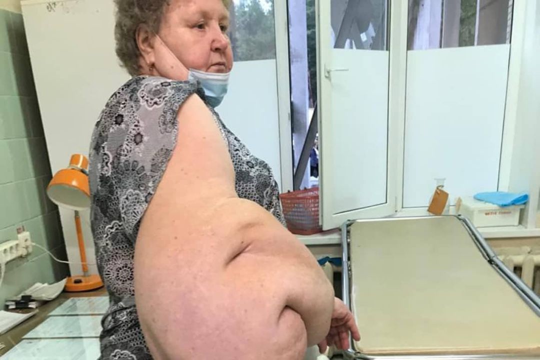 Татарстан табиблары уникаль операция ясаган: бер хатынның кулыннан 20 килограммлы шеш алганнар